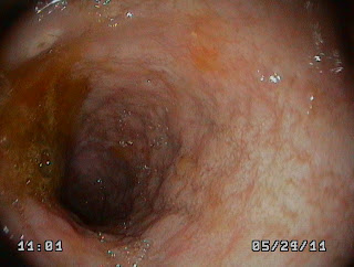 endoscopia